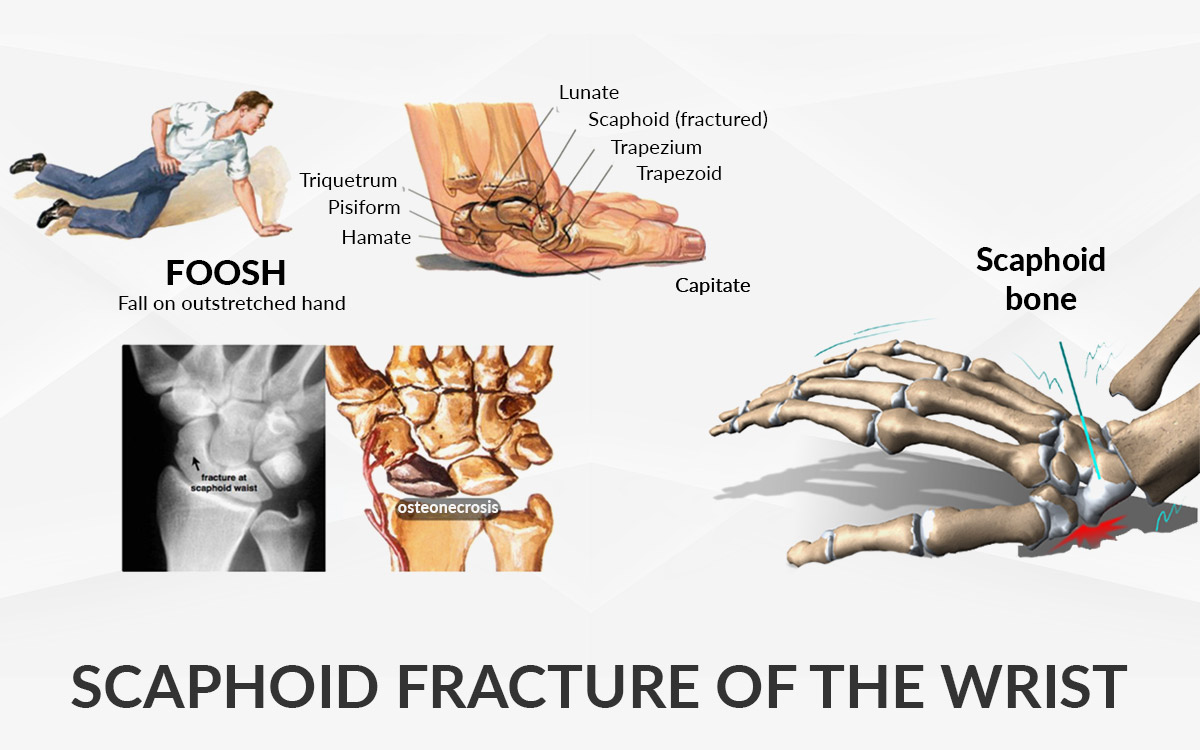scaphoid fracture ízületi fájdalom tünetei az osteochondrosisban